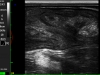 Endometritis chez une vache