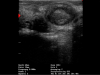 iscan-mini-eierstock-nach-ovulation